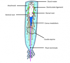 When the roots of the cauda equina are pinched by a lower lumbar disc herniation which causes saddle sensory loss and numbness or muscle weakness in the lower limb