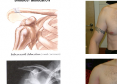 Anterior
Imagine your arm behind the seat to your right and then a blow to the posterior proximal humerus. This is also called the subcoracoid dislocation.