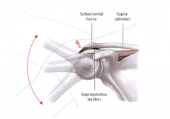 The pain caused when the subacromal bursa or spraspinatus are inflamed and the movement from 60-180 degrees causes joint pain