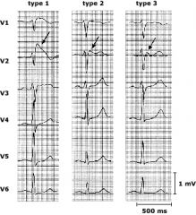 ECG findings in the precordial leads (especially V1, V2, and V3) consisting of a "pseudo-RBBB" (meaning rabbit ears are visible in V1 and V2) and ST-segment elevation.

Type 1 is the most obvious type, with down-sloping ST elevation in V1 or V2 ...