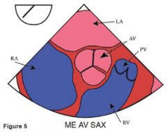 Angle: 25-45 degree 

Diagnostic uses 
1. AV morphology 
2. AS/ regurg 
3. coronary arteries 
4. air in roof of LA 

