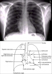 Normal Chest X ray