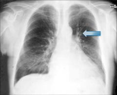 Chest X-ray in CHF

Vascular redistribution and prominent cardiac silhouette