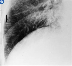 Chest X-ray in CHF

Kerley “B” lines:

Suggest interstitial edema

Look like horizontal lines perpendicular to the lateral aspects of the lower lungs