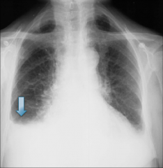 CXR with pleural effusion

Pleural fluid in CHF:

Usually occurs on the right
side first.

Blunting of the “costo-phrenic” 
angles

Layering out of fluid with 
Patient lying on their side