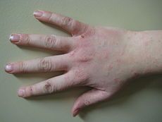 Itchy macules
Can be in response to numerous antigens.
recurring episodes
Cause: Type I hypersensitivity (IgE) rxn
RF: Asthma and allergic rhinitis
