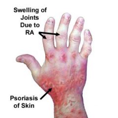 30% of psoriasis pts
Sx: similar to RA
Dx: psoriasis pt with RA sx but (-) RF