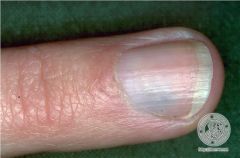 Rare, benign tumor found under the nail bed
From dermal glomus bodies (thermoregulators shunt blood )