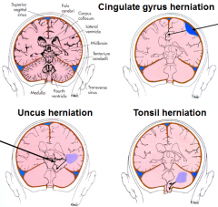 - cingulate gyrus herniation (subdural hematoma)
- uncus herniation ) herniation through tentorial notch - presses midbrain)
- tonsil herniation (tonsil of cerebellum herniated through foramen magna - compresses medulla - shuts down cardiovascul...