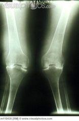 A 65-year-old male undergoes a primary total knee arthroplasty. His preoperative radiographs are seen in figures A and B. Postoperative examination reveals an inability to dorsiflex his ankle or extend his toes. Sensation is decreased along the do...