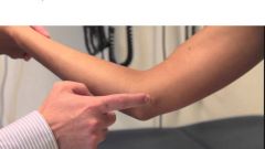 - median nerve compression between 2 heads of pronator teres
- repetitive pronation/supination and excessive pressure on proximal forearm by the elbow
- positive Tinel's sign, tingling and numbness in palm, thumb, 3rd fingers, & aching in proximal...
