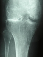 Hx:55-year-old patient is scheduled for total knee arthroplasty. A radiograph is provided in Figure A. Each of the following are risk factors for heterotopic ossification EXCEPT? 1.  Valgus knee deformity; 2.  Male gender; 3.  Obesity; 4.  History...