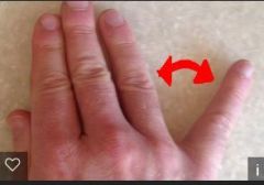 - repetitive strain, ganglion, pressure, fascial thickening causing compression of ulnar nerve through the canal


- positive Tinel's sign at canal, positive Wartenberg's sign, numbness/tingling on ulnar side, motor weakness, can lead to atrophy o...
