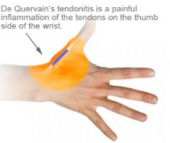 What is the etiology of DeQuervain's tenosynovitis? How is it identified? How is it treated?