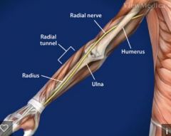 What is the etiology of radial tunnel syndrome? How is it identified? How is it treated?