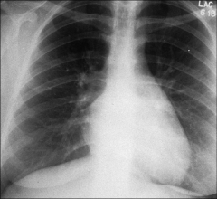 *CXRay in MS:
-Straightening Left Heart border
-Elevated Left main bronchus (not well seen here)
-“Double Density” of enlarged LA behind LV.
-Pulmonary congestion.
