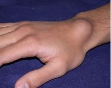 What is the etiology of Ganglion Cysts? How are they identified? How are they treated?