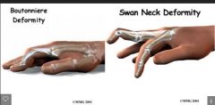 Swan neck deformity and boutonniere deformity are the results of what disease?