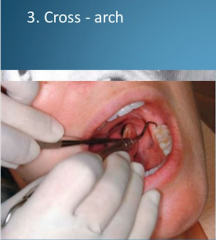 finger rest established on tooth surfaces on the other side of the same arch