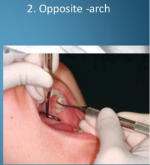 finger rest established on tooth surfaces on the opposite arch