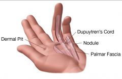 What is the etiology of Duptryen's Contracture? What are the symptoms? What is the treatment?