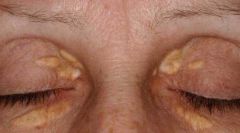 cutaneous lesion with lipids (on microscopy)
commonly on eyelid
associated with primary hyperlipidemia and secondary hyperlipidemia (biliary cirrhosis, cholecystitis)