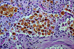 LUNG HEART FAILURE CELLS
Yellow-brown pigment= iron (hemosiderin) containing macrophages