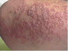 itchy, burning skin rash that looks like HSV/varicella (herpetiformis) with filled vesicles
Associated with celiac disease/gluten sensitivity (HLADQ2)
Dx: IgA Ab (blood) or DFA IgA deposits (skin)