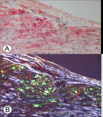 CARDIAC AMYLOIDOSIS
A= Congo Red; Red=amyloid
B= Congo Red Polarized; Green= Amyloid and White= Collagen