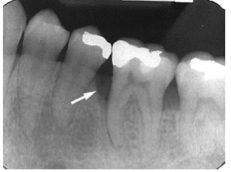 perpendicular plane with plane of alveolar bone, bone loss appears as "V" shape adjacent to tooth


-normally posterior, associated with infra bony pocket
