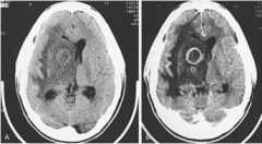 Headache is the most common presenting symptom. Sudden worsening of the headache with onset of meningismus may signify rupture into the ventricular space. Imaging will show hypodense center with ring enhancement surrounded by a hypodense area of b...