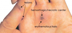 Pattern recognition
Monoarthritis with tender pustular lesions on an erythematus base and haemorrhagic papules
