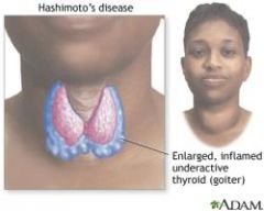 aid cell mediated
ex)  hashimotos disease