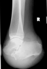 Chopart amputation removes the forefoot and midfoot, saving talus and calcaneus;

this is a very unstable amputation, noting that most of the tendons which act around the ankle joint have lost their insertion into foot and the heel remains unsta...