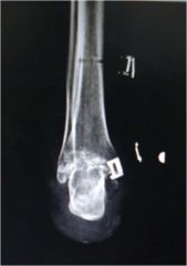 amputation at the ankle with removal of the talus and fusion of the tibia and calcaneus.