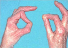 Hx:72yo f c/o progressive weakness with grasp and key pinch in L hand. PE of the hand is significant for decreased sensation on the volar aspect of the 4&5 digits. Dorsal sensation throughout the hand is nl. A clinical photo displaying b/l key pin...