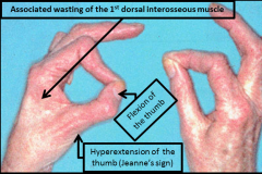 Compression of the ulnar nerve within Guyon's canal, termed ulnar tunnel syndrome, is most commonly caused by a ganglion cyst. A lack of dorsal ulnar sensory deficit helps differentiate entrapment here from at the elbow because the dorsal ulnar cu...