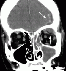 The presentation is typically insidious (grows slowly due to how close the dura is to the cranium) and can be masked by the primary infection (sinusitis/otitis media). Fever and headache are common and cranial epidural abscesses can be missed unti...