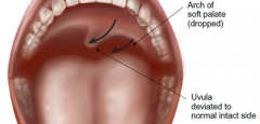 uvula deviation - to unaffected side