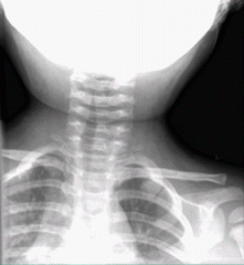 Based on clinical syndromes and characteristic "steeple sign" see on AP radiograph. 


Treatement is dexamethasone and supportive care. If severe can give nebulized racemic epinephrine. 