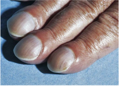 Inner nail elevates. Nail bed is greater than 180 degrees.