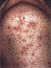 Superficial infection of hair follicles. Consists of multiple pustules with visible white heads and an erythemateous base.