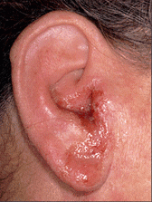 Patients with otitis externa will have a pruritic and painful outer ear. It will be painful on palpation. Usually caused by P. aeruginosa from swimming or water being trapped in ear canal in hot/humid weather. 


Chronic otitis externa is a man...