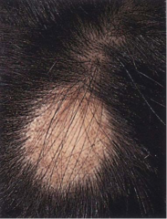 Sudden appearance of sharply circumscribed, round or oval balding patch- usually with smooth, soft skin underneath 