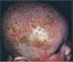 "Cradle Cap"


Thick yellow (to white), greasy adherent scaling w/ mild erythema on scalp and forehead. Common in early infancy.