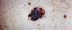 Malignant skin tumors. 


 


Identify via the "ABCDE method"