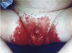 Scalding red moist patches with sharply demarcated borders and some loose scales.


 


Usually in genital areas. 