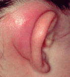 Typically in the setting of an acute otitis media. Will see edema, tenderness and erythema over mastoid bone. The pinna will be displaced outward and downward. There may also be purulent discharge. Treatment is the same as acute otitis media. A ma...