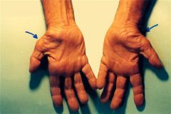 carpal tunnel canal pressure varies with wrist position. Use of neutral wrist splints for carpal tunnel syndrome is most useful for improving noctural sx. The reason for this is the functional position of the wrist is approximately 30 deg of exten...