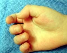 Hx:2yo C has a flex deformity of the IPJ of his thumb Fig A. Surgical correction of this deformity places what structure most at risk as it crosses the surgical field?  1-Princeps pollicis artery; 2-Ulnar digital nerve; 3-Oblique pulley; 4-Ulnar d...